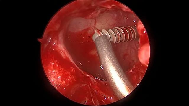 Удаление инородного тела верхнечелюстной пазухи. Maxillary sinus foreign body removal. смотреть онлайн