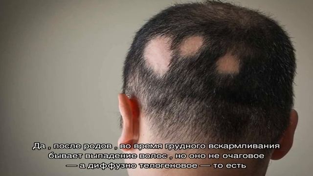 Очаговая алопеция: как быстро лечить? смотреть онлайн