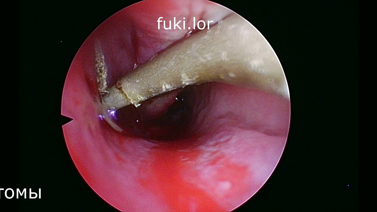 Удаление многокамерной кисты верхнечелюстной пазухи инфрамеатальным доступом