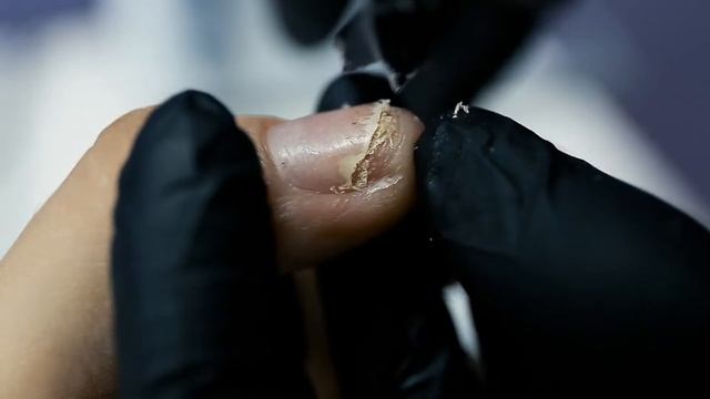 "Онихолизис. Методика обработки. Протезирование" трейлер видеокурса смотреть онлайн