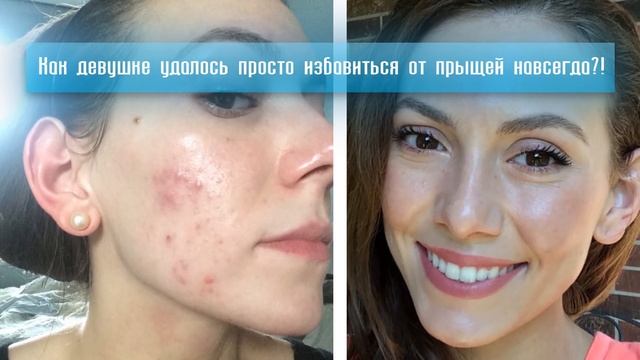 Копеечное Средство от Прыщей? смотреть онлайн