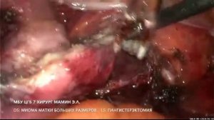 Миома матки больших размеров. Лапароскопия. Пангистерэктомия.