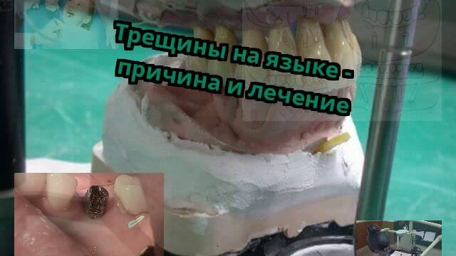 Трещины на языке - причина и лечение смотреть онлайн
