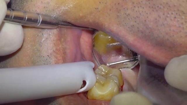 DIFFICULT CASE - ALMOST IMPOSSIBLE TO ISOLATE WITH RUBBER DAM смотреть онлайн