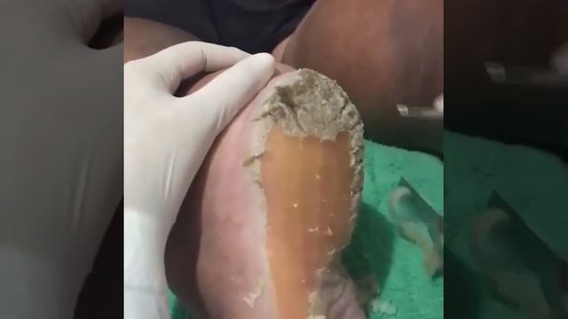 чистка пяток