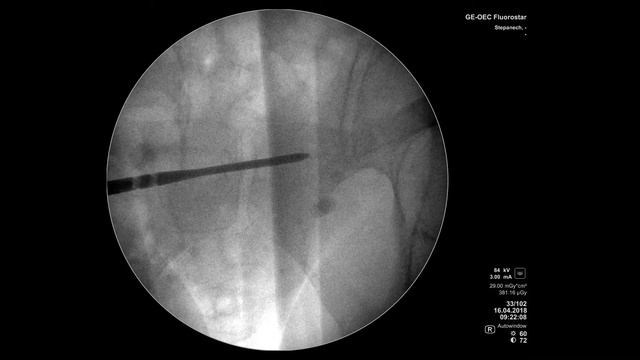 Interlocking intramedullary nailing for pubic rami fractures. Nsn™ смотреть онлайн