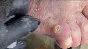 Обработка стержневой мозоли