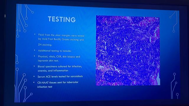 Hansens Disease Powerpoint presentation смотреть онлайн