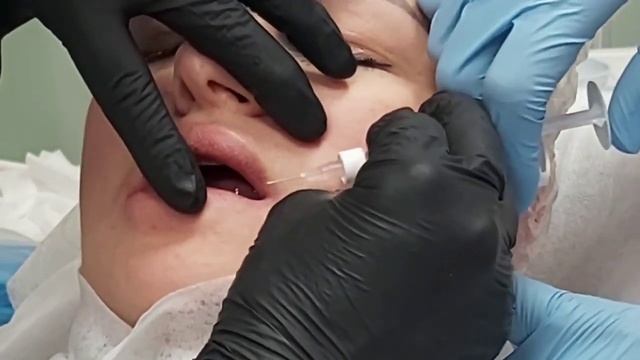 АирисКом студенты учатся: практика учеников. Контурная пластика лица. Коррекция углов рта.