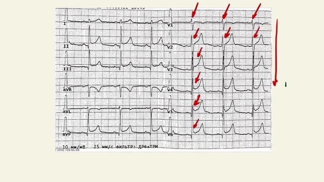 Анализ ЭКГ. Пошаговый разбор. смотреть онлайн