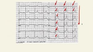 Анализ ЭКГ. Пошаговый разбор.