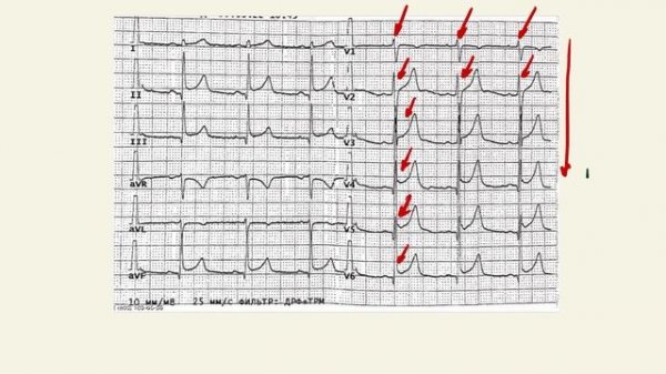 Анализ ЭКГ. Пошаговый разбор.