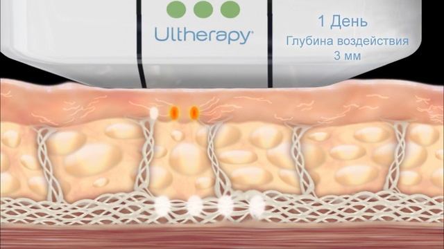 Как работает Альтера (ulthera) смотреть онлайн