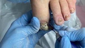 Земля под ногтями / Толстый ноготь / Онихогрифоз / Есть ли тут грибок? Что с ногтем?