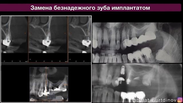 Замена металлокерамических коронок на коронки из диоксида циркония. смотреть онлайн