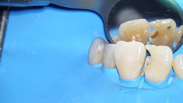 Step by Step Class III Composite Restoration | Dentist Griya RR смотреть онлайн
