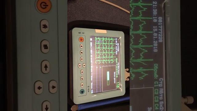ЭК12Т Е 104. Снятие и передача ЭКГ по телефону смотреть онлайн
