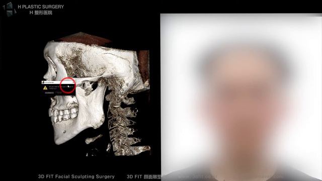 I Wonder If I Have A Small Chin And Which Will Help Between Implanting Or Advance Genioplasty