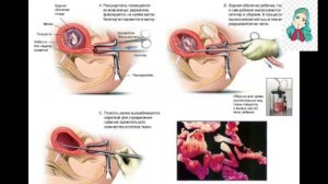 Хомилани тушуриш нобуд килиш хакида