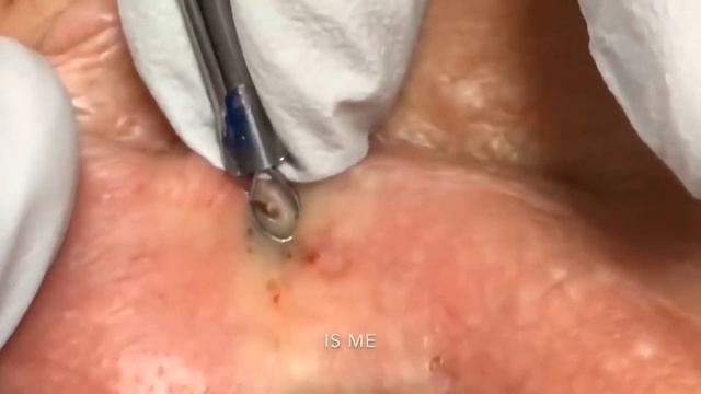 Удаление чёрных точек на лице. Лечение акне. Как убрать черные точки? Чистка лица. Прыщи на лице. смотреть онлайн