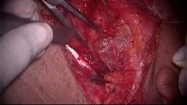 Sialolithiasis | Left Submandibular gland excision | Dr Satish Jain смотреть онлайн