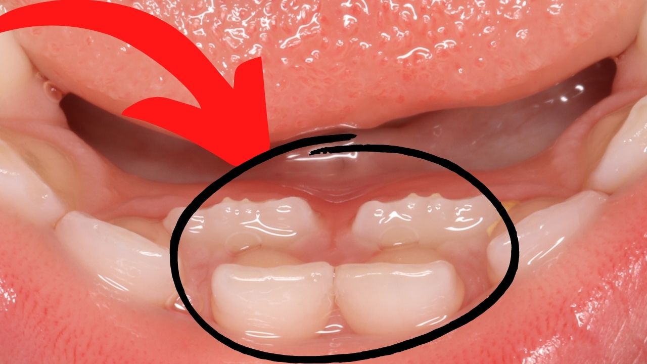 Зубы растут в 2 ряда. Что делать?