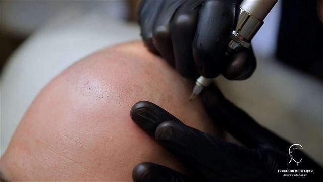 Трихопигментация - лучше чем пересадка волос! Scalp MicroPigmentation смотреть онлайн