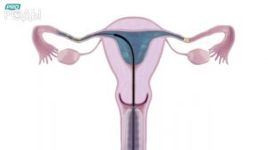 Гистеросальпингография