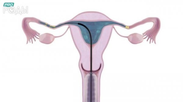 Гистеросальпингография