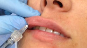 Студенты учатся. Техника введения ФИЛЛЕРА В ГУБЫ для поддержания ЕСТЕССТВЕННОЙ и натур. формы губ.