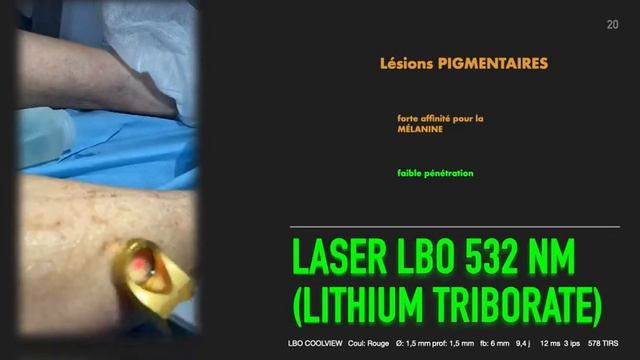 Laser Excel V+: Varices réticulaires, télangiectasiques, et lésions pigmentaires - CUCF, PARIS 2022 смотреть онлайн
