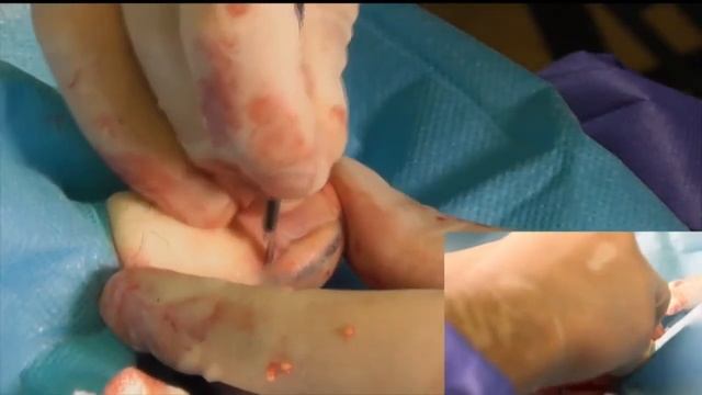 Plastyka Wałów Okołopaznokciowych /The Treatment Of Ingrown Toenails By Arkada’s Method - Part 2