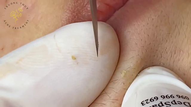 🔥 Выдавливание прыщей | Удаление и выдавливание прыщей и черных точек 2021 | Прыщи выдавливание #01