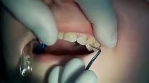 Реставрация резца и клыка фотополимерным композитом.