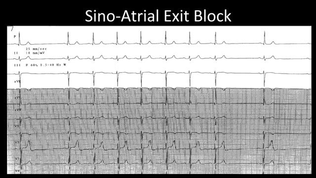 How to Read an ECG: Sinoatrial Node Bradycardias / Sinus Pauses or Arrests / Tachy-Brady Syndrome смотреть онлайн