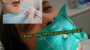 Как чистят каналы зуба?