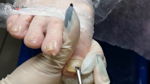 Скрученные ногти на ногах. Классический педикюр, обработка пальцев ног. Покрытие лаком Kinetics