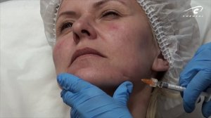 Поднимаем уголки рта канюлей. Контурная пластика филлерами Princess.