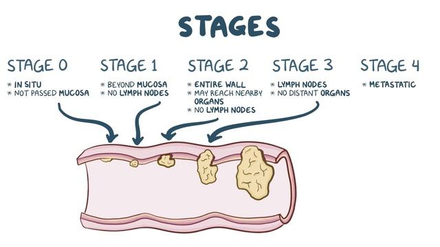 Colorectal carcinoma - causes, symptoms, diagnosis, treatment, pathology.mp4 смотреть онлайн
