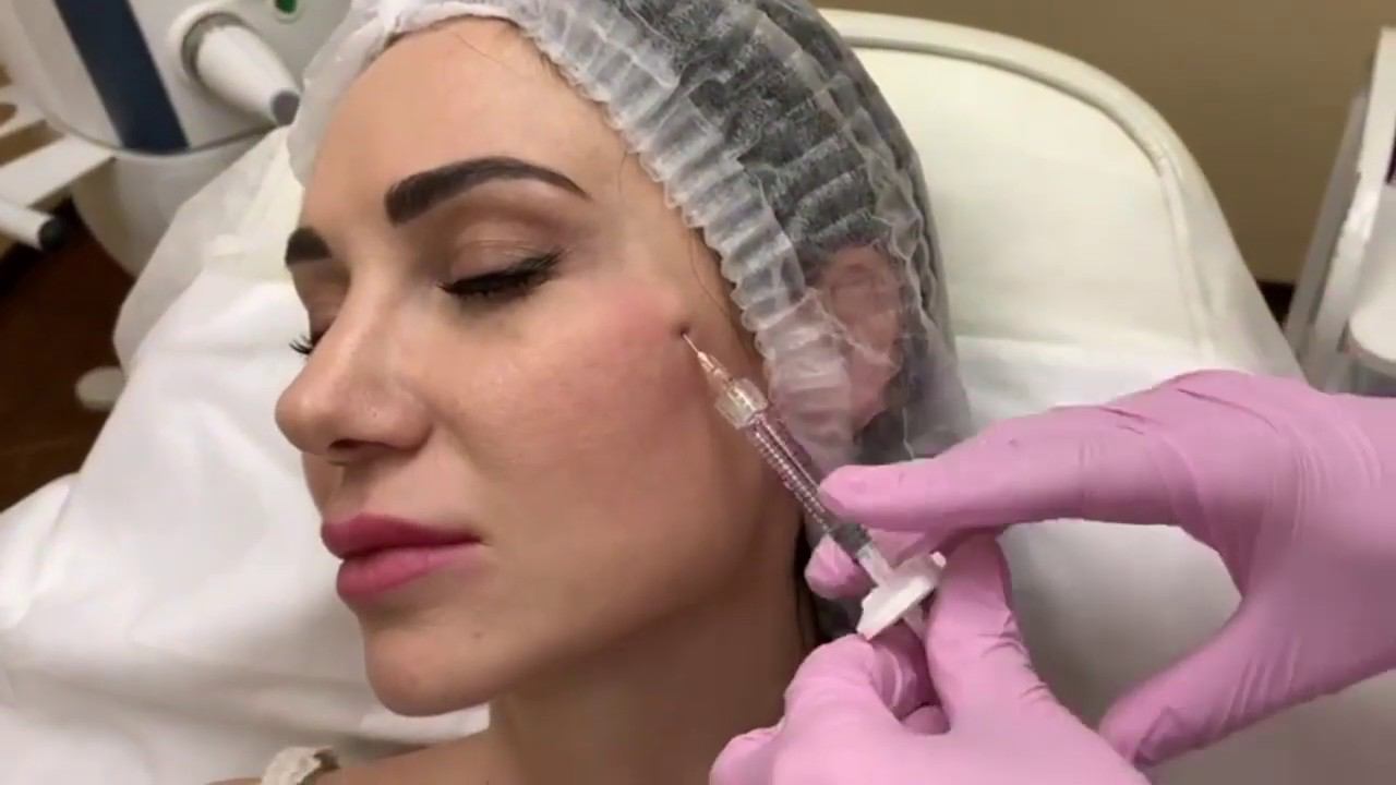 КОНТУРНАЯ ПЛАСТИКА височной области смотреть онлайн