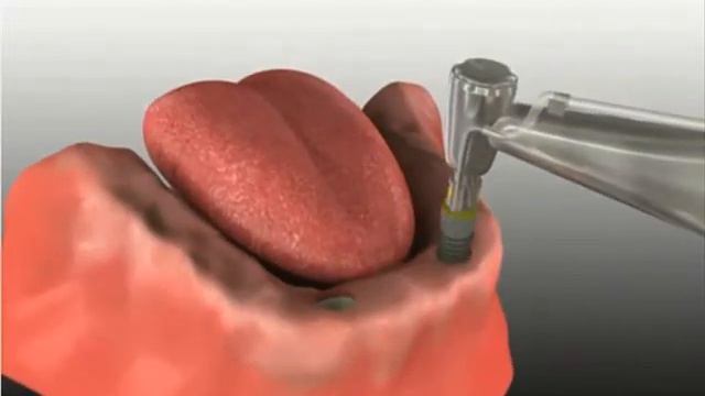 Prosthodontics - Denture Stabilization - Протезирование зубное в Краснодаре - ДокторСтом смотреть онлайн