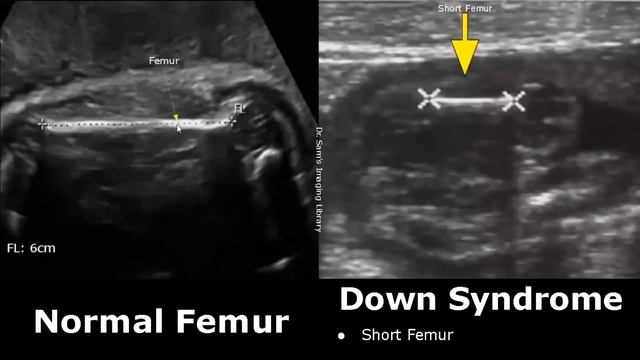 Fetal Ultrasound Normal Vs Down Syndrome | Soft Markers In Fetus For Trisomy 21 | Aneuploidies USG смотреть онлайн