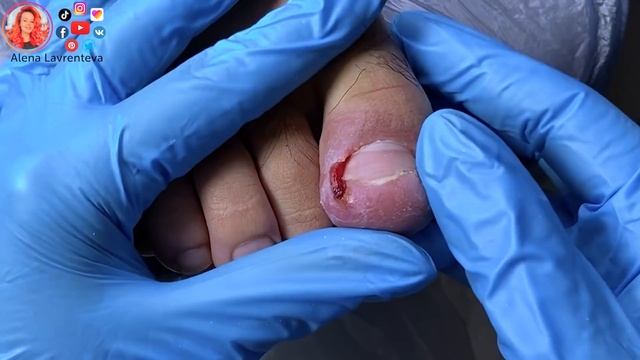 Вросший ноготь на ноге / Гной под ногтем смотреть онлайн