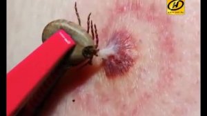 Опасные клещи для человека  Чем опасен иксодовый клещ