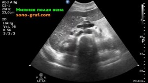 УЗИ - Камни в желчном пузыре