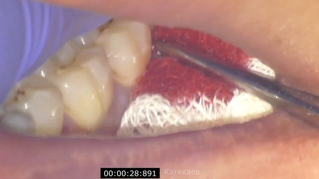 Удаление зуба мудрости