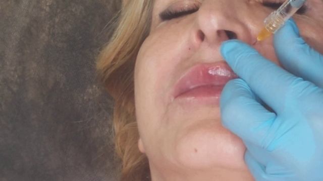 Нос. Филлер(фрагмент) смотреть онлайн