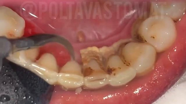 Большой Зубной Камень - Scaling/Teeth Tartar смотреть онлайн