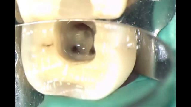 Удаление гноя из канала зуба, Острый гнойный периодонтит. смотреть онлайн
