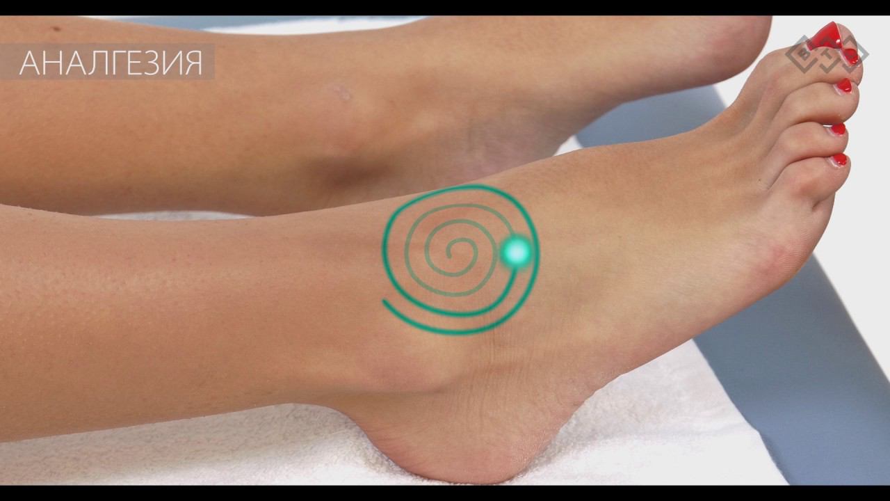 Вывих лодыжки. Терапевтическое видео: Лазер высокой интенсивности BTL-6000 HIL. смотреть онлайн
